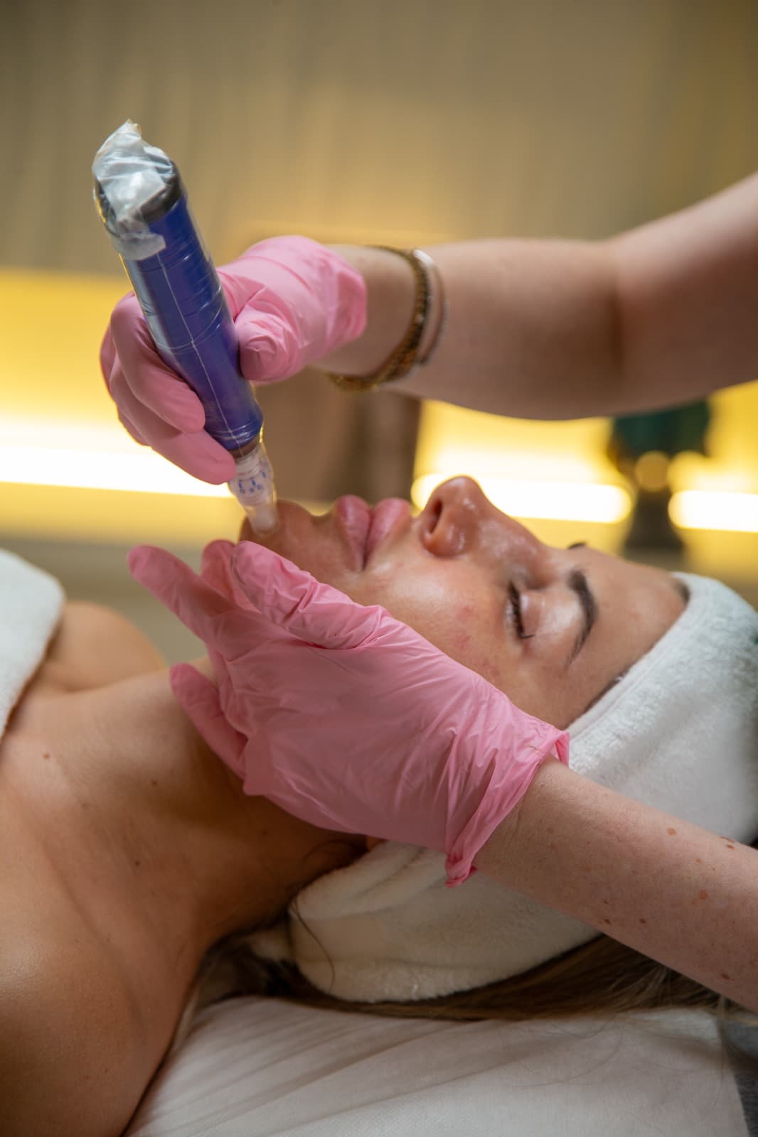 SkinPen Microneedling